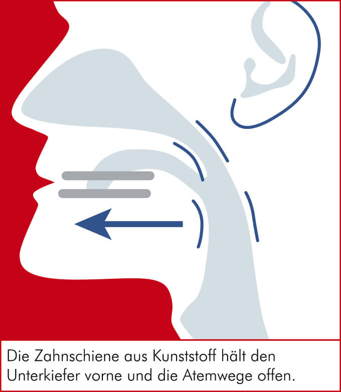 Schnarcherschiene